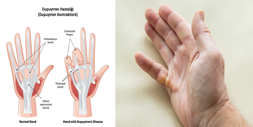 dupuytren