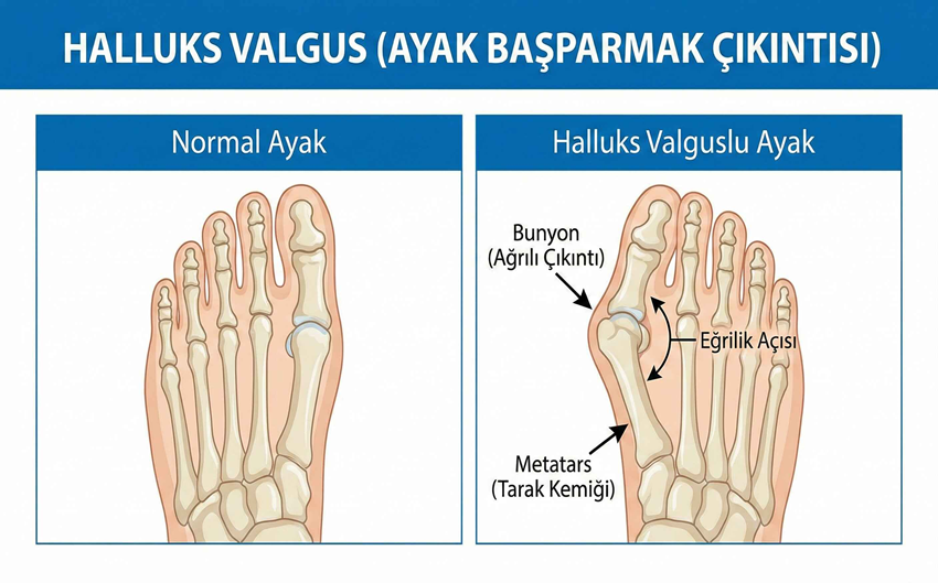halluksvalgus