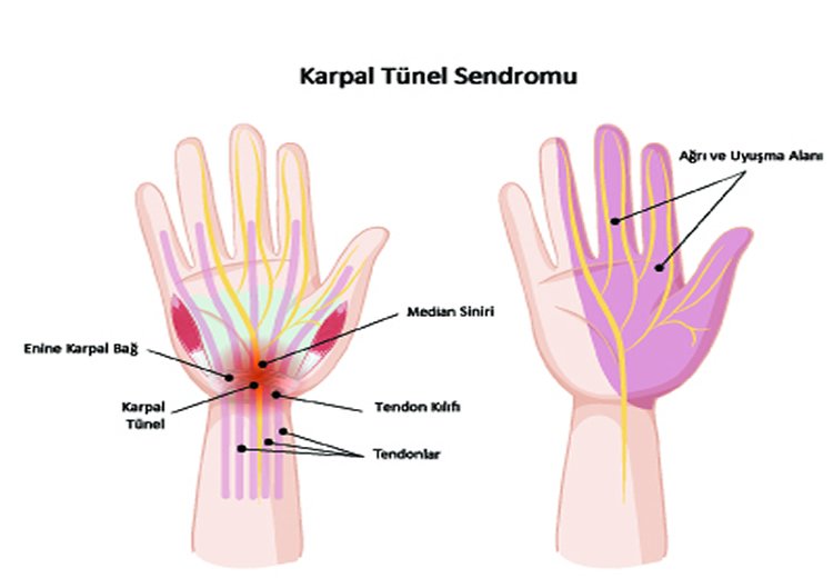 karpal-tünel-sendromu