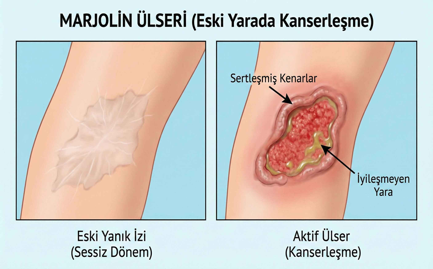 marjolinülseri