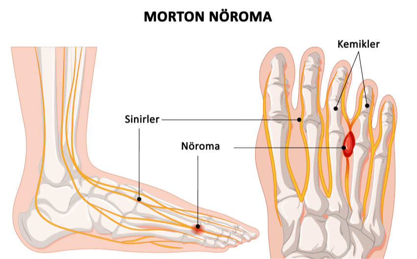 mortonnöroma
