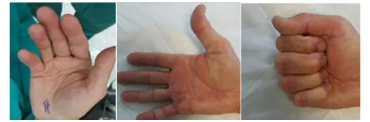 dupuytrenkontraktürü